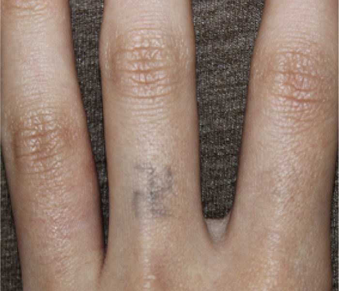 症例1　刺青（タトゥー）除去（レーザー） 19歳女性 治療前