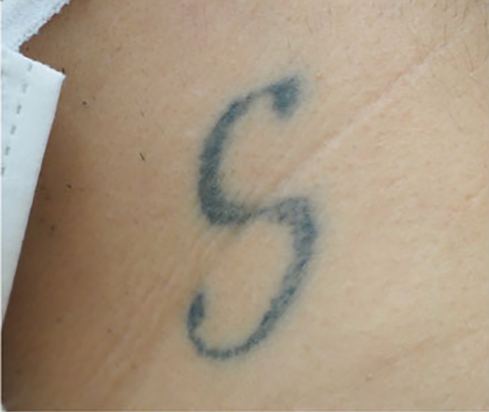 症例3　刺青（タトゥー）除去（レーザー） 30歳男性 治療前