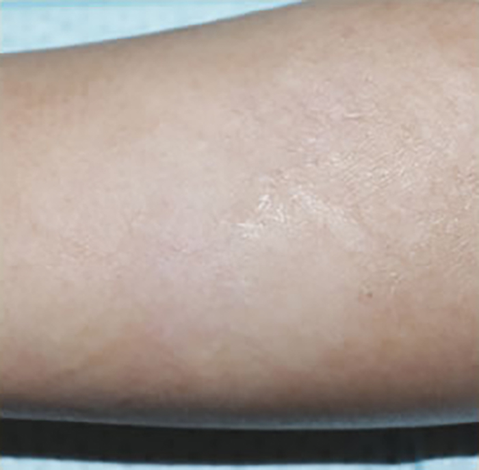 症例5　刺青（タトゥー）除去（切縫法） 27歳女性 手術後
