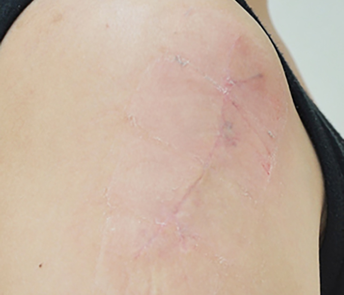 症例6　刺青（タトゥー）除去（切縫法） 28歳女性 手術後