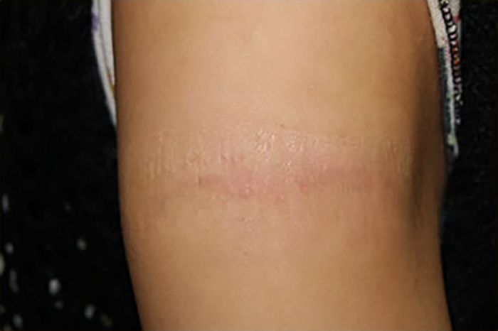 症例7　刺青（タトゥー）除去（切縫法） 24歳女性 手術後
