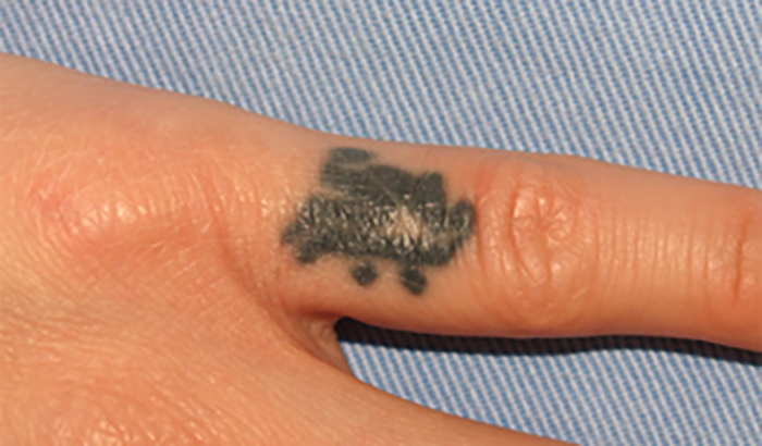 症例9　刺青（タトゥー）除去（植皮法） 27歳女性 手術前