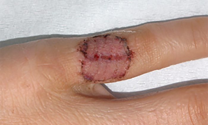 症例9　刺青（タトゥー）除去（植皮法） 27歳女性 手術後10日目