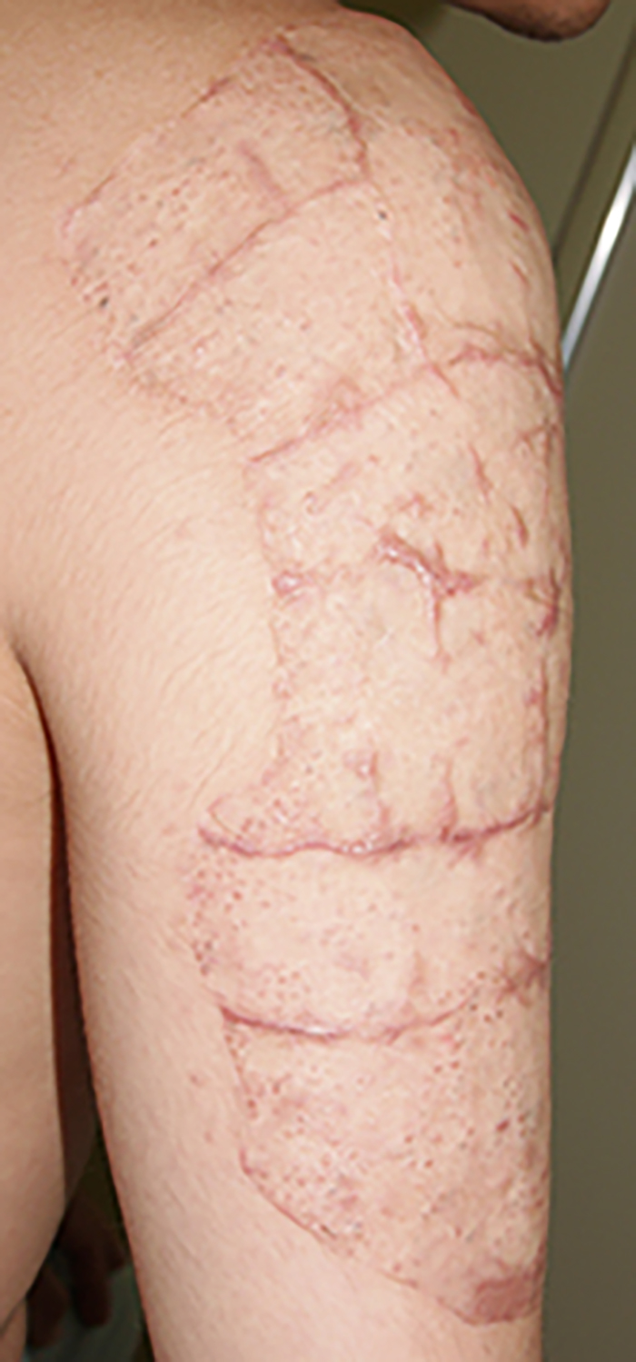症例10　刺青（タトゥー）除去（植皮法） 35歳男性 手術後