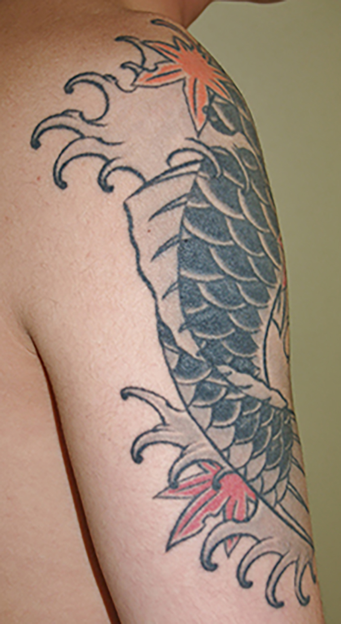 症例10　刺青（タトゥー）除去（植皮法） 35歳男性 手術前