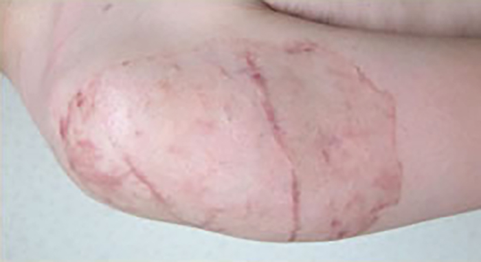 症例11　刺青（タトゥー）除去（植皮法） 23歳男性 手術後9ヶ月