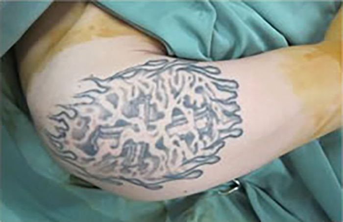 症例11　刺青（タトゥー）除去（植皮法） 23歳男性 手術前
