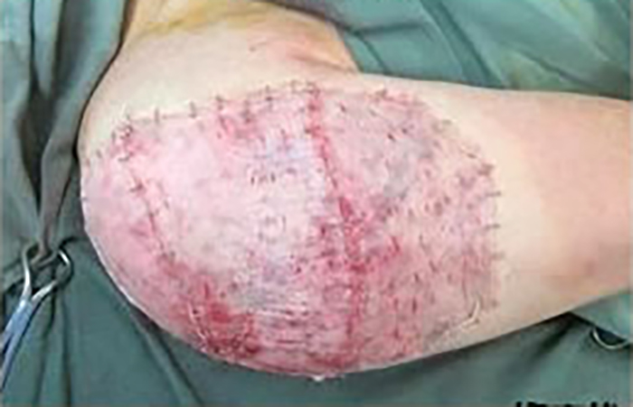 症例11　刺青（タトゥー）除去（植皮法） 23歳男性 手術直後