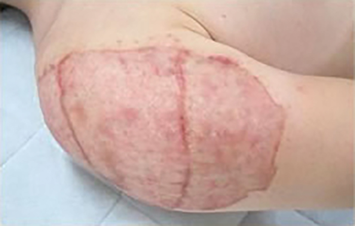 症例11　刺青（タトゥー）除去（植皮法） 23歳男性 手術後1ヶ月半