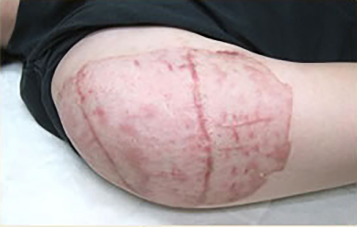 症例11　刺青（タトゥー）除去（植皮法） 23歳男性 手術後2ヶ月半