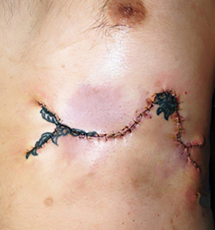 刺青（タトゥー）除去（皮膚組織伸展法） 32歳男性 手術直後