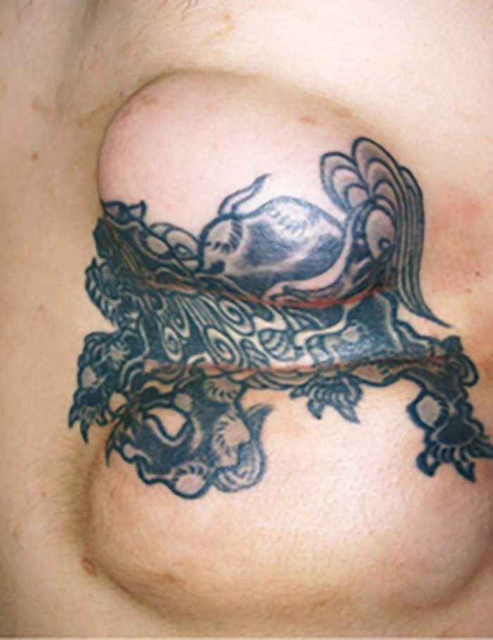 刺青（タトゥー）除去（皮膚組織伸展法） 32歳男性 経過中